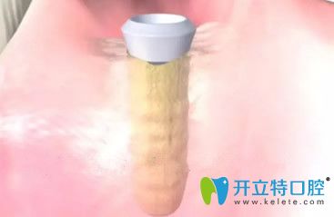 种植体与牙槽骨结合好后要安装基台 种植体与牙槽骨结合好后要安装基台