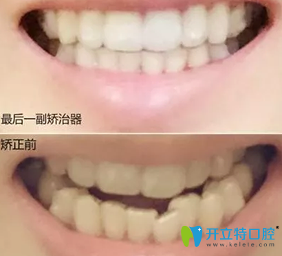 牙齿矫正有危害吗？广州诺尔口腔28岁隐形矫正牙齿前后展示