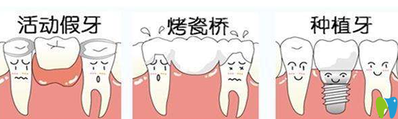 广州诺尔口腔种植牙和镶牙对比图
