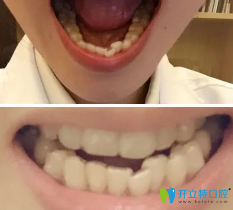 我在广州诺尔口腔做牙齿矫正前的照片