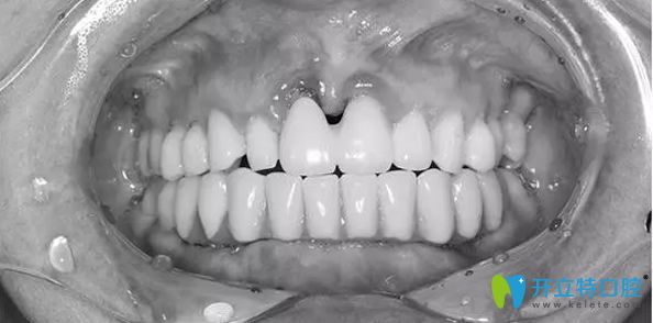 太平洋口腔牙齿种植后的效果