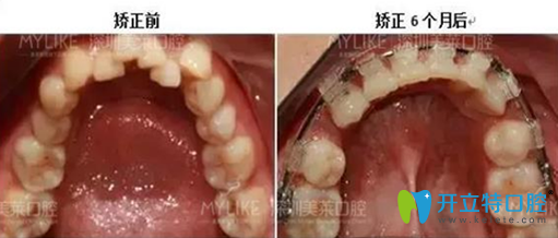 深圳美莱口腔28岁矫正牙齿半年前后图