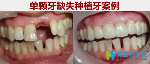 单颗牙缺失种植牙前后对比效果图