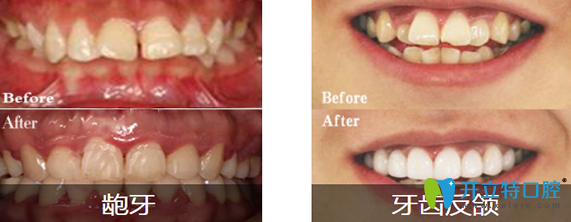 汪洋齿科“龅牙”矫正+牙齿反颌矫正前后对比照片