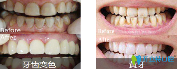 汪洋齿科牙齿变色+黄牙美白前后对比照