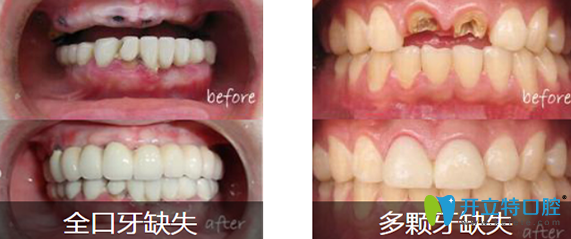 深圳汪洋齿科全口牙缺失+多颗牙缺失种植前后对比图