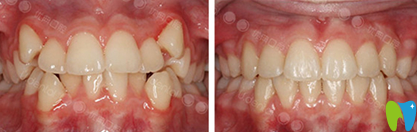 广州优典口腔曹阳医生隐形牙齿矫正前后效果对比图