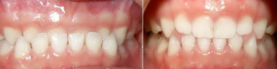 3岁儿童乳牙反颌怎么办 看深圳欢乐口腔展示的牙齿矫正案例