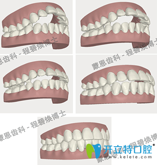 蒙恩齿科程碧焕为我做的隐适美牙齿矫正3D效果图 蒙恩齿科程碧焕为我做的隐适美牙齿矫正3D效果图