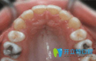 宏山齿科牙齿矫正后图片 宏山齿科牙齿矫正后图片