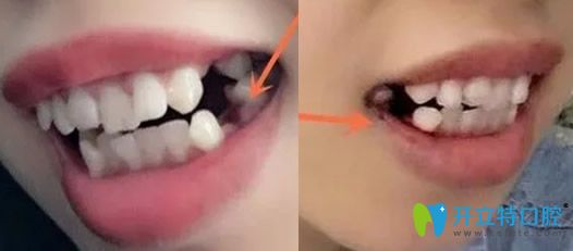 深圳汪洋齿科牙齿矫正拔4颗牙后的照片