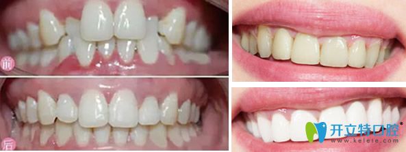 深圳欢乐口腔牙齿矫正和黄牙美白案例