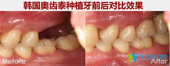 韩国奥齿泰种植牙前后对比照片