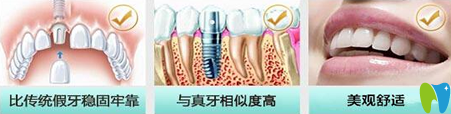 长沙雅美口腔门诊种植牙优点介绍图