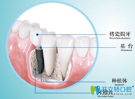 长沙雅美口腔种植牙介绍图