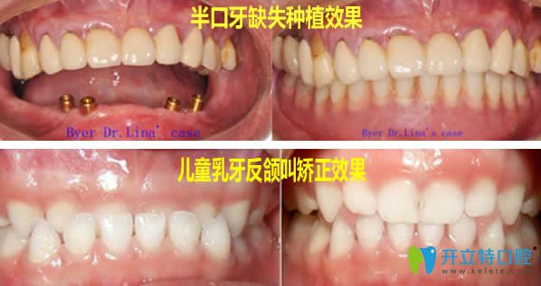半口牙缺失种植+儿童乳牙反颌矫正案例