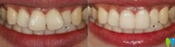深圳杜航口腔牙齿正畸前后对比图