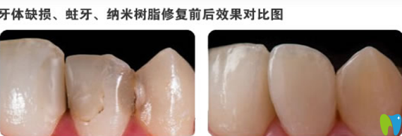 拜博口腔纳米树脂补牙修复牙治疗前后对比照片