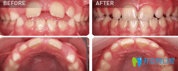 16岁孩子在东莞拜博口腔做MRC正牙宝牙齿矫正案例对比图