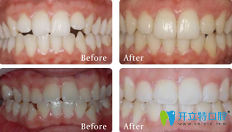 韶关优牙口腔牙齿矫正前后效果对比图