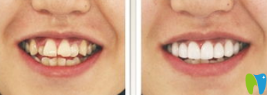 湛江南方口腔黄宏医生隐形牙齿矫正前后效果对比图