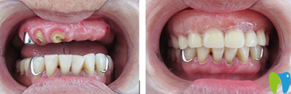 南方口腔种植牙前后效果对比图