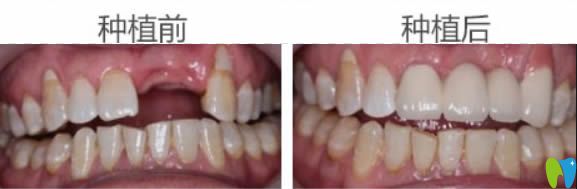 东莞固德口腔周毅门牙缺失种植牙案例图 东莞固德口腔周毅门牙缺失种植牙案例图