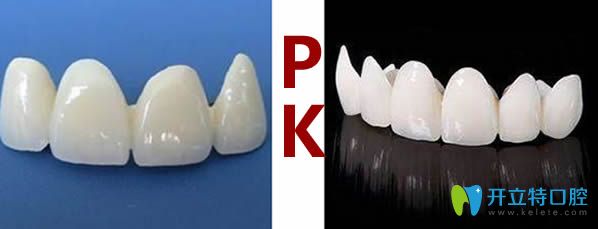 铸瓷牙和二氧化锆全瓷牙哪个好?从价格及材质上看有啥区别