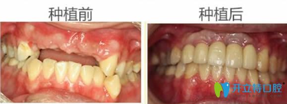 东莞固德周毅院长全口牙缺失种植前后对比效果 东莞固德周毅院长全口牙缺失种植前后对比效果