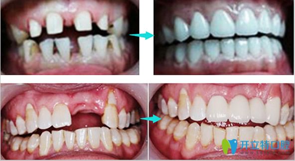 爱国口腔牙列稀疏美学修复+多颗牙缺失种植效果案例