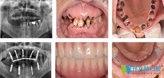 70岁老太在珠江口腔种植牙过程及结果展示