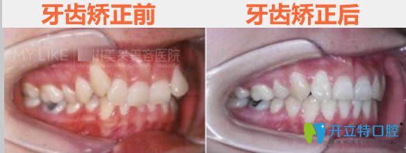 广州美莱28岁顾客牙齿矫正前后对比照
