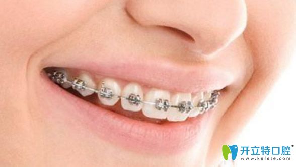 牙齿矫正能有效改善牙缝稀疏