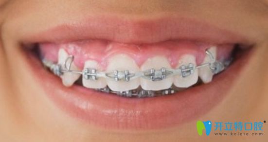 金属托槽是常用矫正牙齿的方法