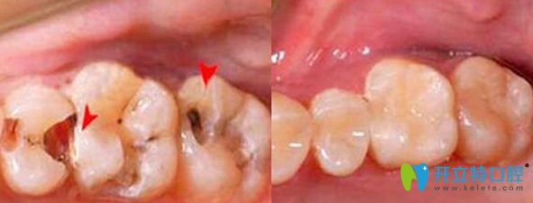 东莞健力口腔牙体修复案例图
