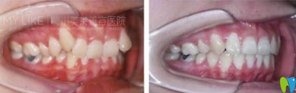 广州美莱口腔科28岁顾客牙齿矫正前后对比照