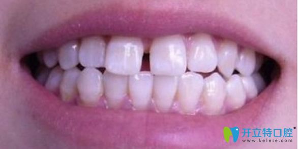 门牙有缝隙该怎么办 看牙齿稀疏的原因及修复矫正方法大全