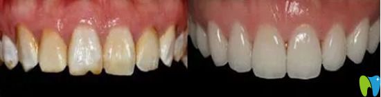 内外冠结合问题是烤瓷牙和全瓷牙的区别之一