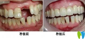 中大口腔种植牙前后效果对比图