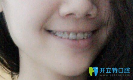 美奥口腔牙齿隐形矫正恢复过程展示