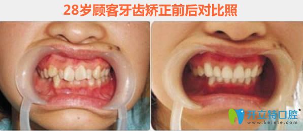 28岁张女士做完牙齿矫正后前后对比照