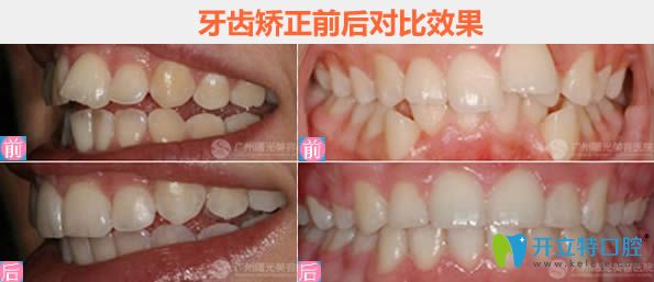 广州曙光牙齿排列不齐及牙齿拥挤矫正对比图
