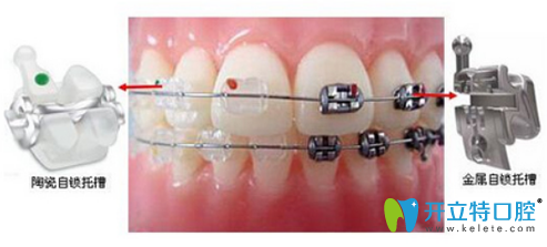 河山齿科自锁托槽牙齿矫正优缺点