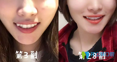 我在广州德伦口腔做隐适美牙齿矫正过程中