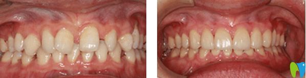 牙齿稀疏+瓷贴面修复效果案例