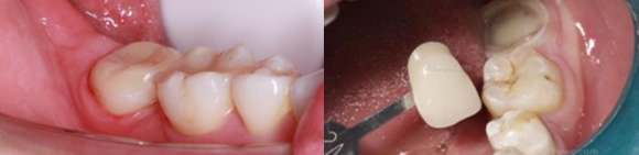 急性牙髓炎怎么办 从中山大象口腔根管治疗案例中找方法