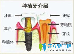 广州好大夫口腔“分分钟”微创无痛即种即用种植牙介绍