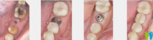 宁波口腔牙齿种植过程及效果