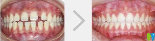 宁波口腔牙列稀疏矫正效果对比图