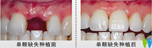 北京嘉和口腔郝国玮医生种植牙前后效果对比图